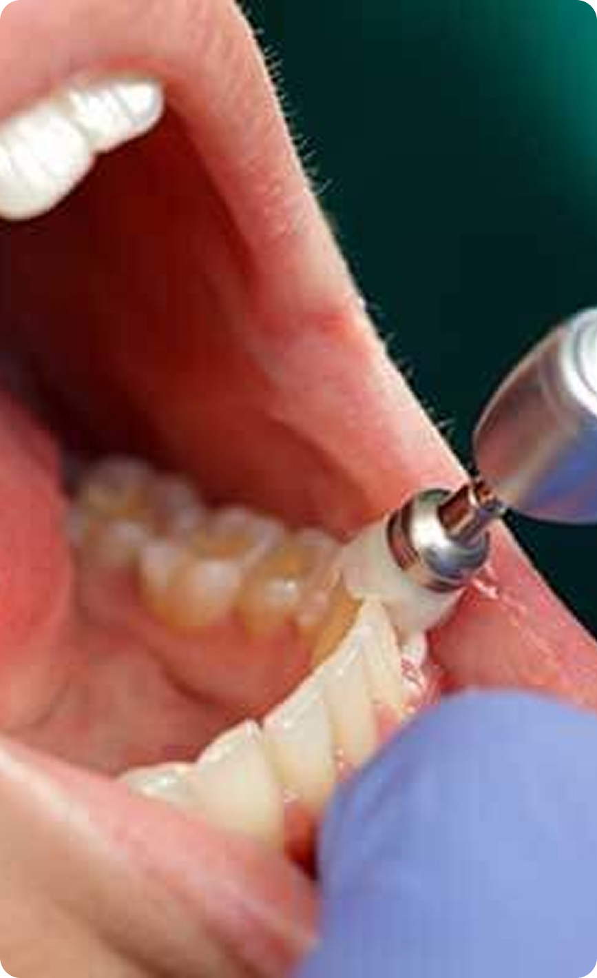 Picture of teeth cleaning